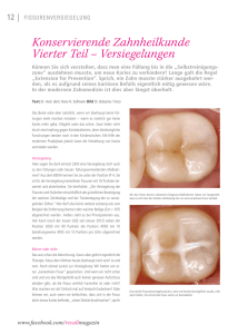 Konservierende Zahnheilkunde Vierter Teil – Versiegelungen
