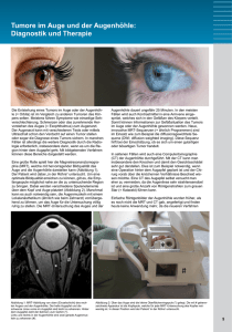 Tumore im Auge und der Augenhöhle: Diagnostik und