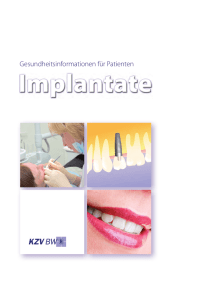 Implantate - Zahnarzt Dr. Hönes