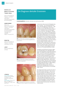 Die Diagnose dentaler Erosionen