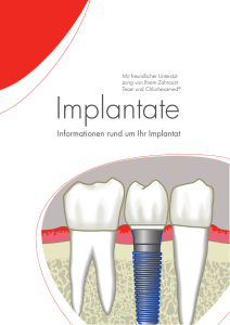 Implantate - zahnarztpraxis Singen