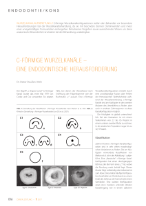 c-förmige wurzelkanäle – eine endodontische