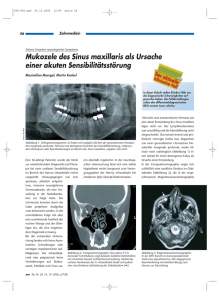 Mukozele des Sinus maxillaris als Ursache einer akuten