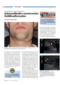 Submandibuläre arteriovenöse Gefäßmalformation
