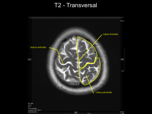 T2 - Transversal