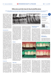 Mikroinvasivität durch Kariesinfiltration