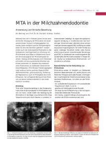 MTA in der Milchzahnendodontie