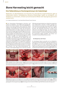 Bone Harvesting leicht gemacht