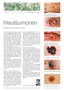 Hauttumoren - Dermatologie Hübscher