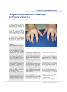 Leitsymptom symmetrische Schwellungen der Fingergrundgelenke