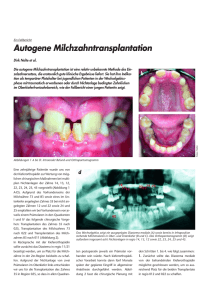 Autogene Milchzahntransplantation - MKG