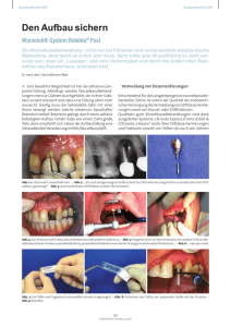 Den Aufbau sichern (Endodontie Journal 04_2008, Deutschland)