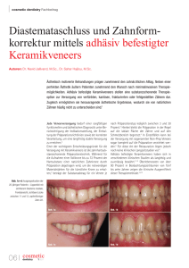 Diastemataschluss und Zahnform korrektur mittels adhäsiv