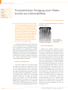 Fertigung einer Klebebrücke aus Lithiumdisilikat