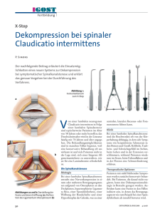 Dekompression bei spinaler Claudicatio intermittens