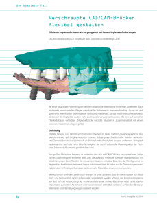 Verschraubte CAD/CAM-Brücken flexibel gestalten