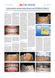 Veneers aus VITABLOCS Mark II