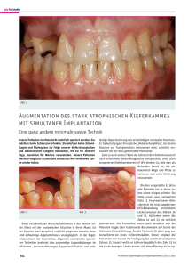 Augmentation des stark atrophischen Kieferkammes