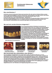 Was sind Brücken - Zahnarztpraxis Dr. Thomas Friedrich, Zeitz