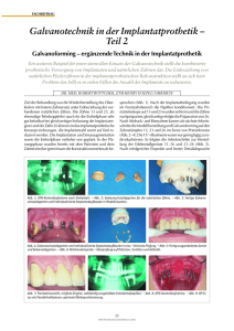 Galvanotechnik in der Implantatprothetik – Teil 2