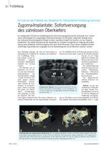 Zygoma-Implantate: Sofortversorgung des zahnlosen Oberkiefers