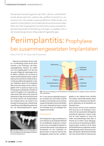 SP0708_20-25_Periimplantitis (Page 1)