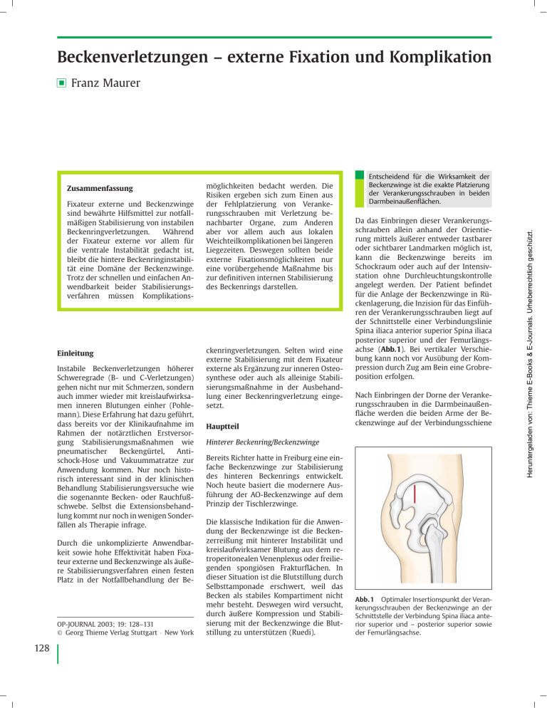 Beckenverletzungen – Externe Fixation Und