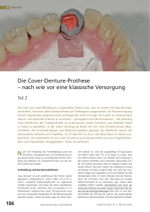 Die Cover-Denture-Prothese – nach wie vor eine klassische