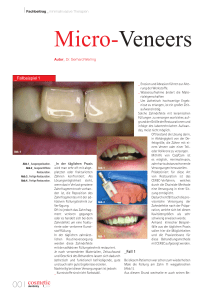 Micro-Veneers - Werling Consulting