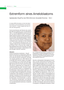 Extremform eines Ameloblastoms