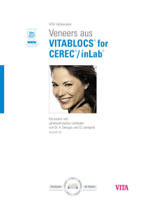 Veneers aus VITABLOCS® for CEREC®/inLab