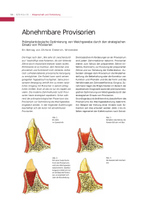 Abnehmbare Provisorien