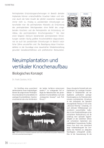 Neuimplantation und vertikaler Knochenaufbau