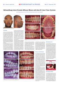 Behandlung eines frontal offenen Bisses mit dem K