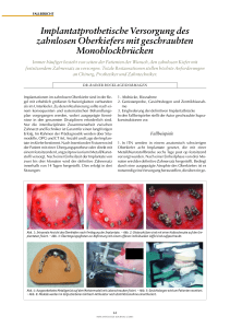 Implantatprothetische Versorgung des zahnlosen