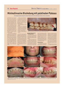 Minimalinvasive Bisshebung mit palatinalen Plateaus