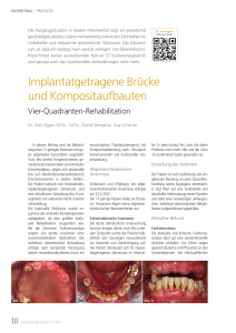 Implantatgetragene Brücke und Kompositaufbauten