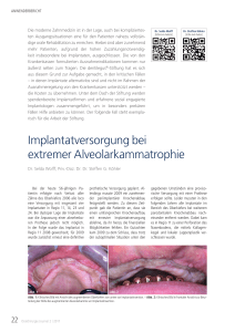 Implantatversorgung bei extremer Alveolarkammatrophie