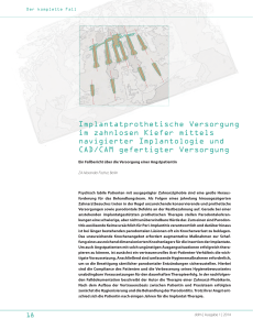 Implantatprothetische Versorgung im zahnlosen Kiefer mittels
