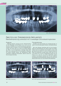 ZZ - dent