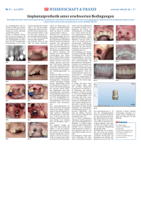 Implantatprothetik unter erschwerten Bedingungen