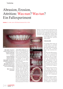 Abrasion, Erosion, Attrition - Dental Tribune International